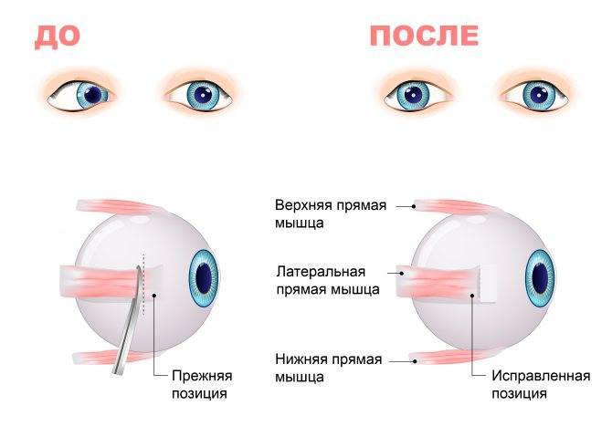 Со скольки лет детям можно носить контактные линзы oculistic.ru
со скольки лет детям можно носить контактные линзы
